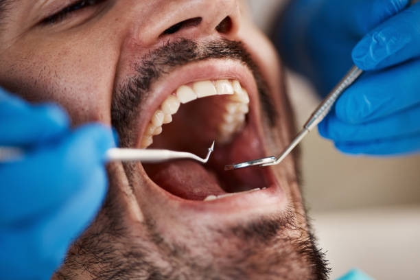Best Emergency Dentist for Lost Fillings or Crowns in West Belmar, NJ