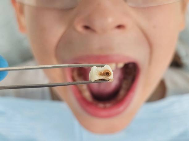 Best Emergency Dentist for Lost Fillings or Crowns in West Belmar, NJ